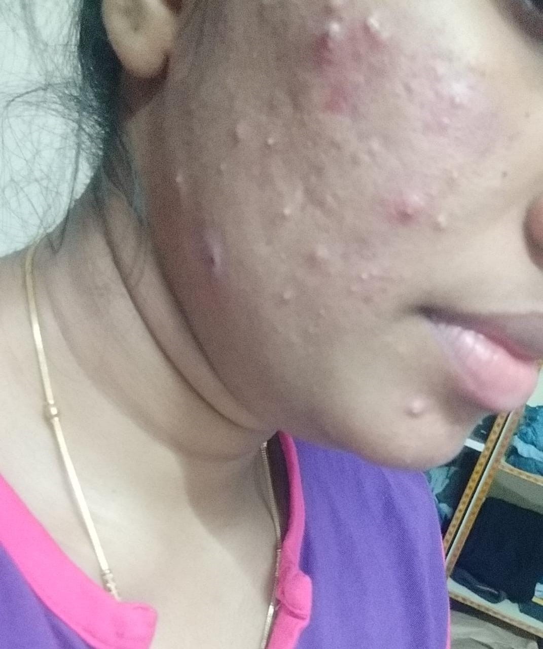 Acne Vulgaris 4